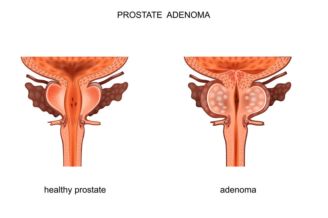 prostate saine et avec adénome